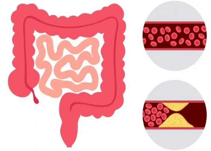 Ischemic colitis