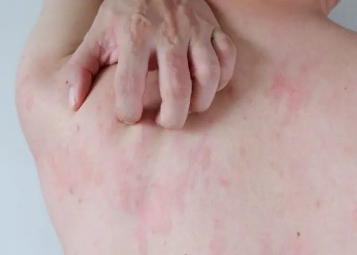 Itchy skin (pruritus)