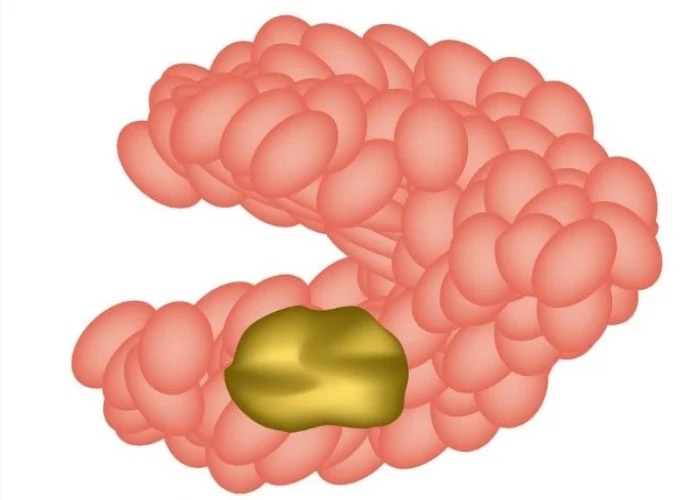 Jaw tumors and cysts