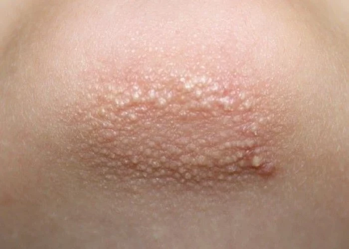 Keratosis pilaris