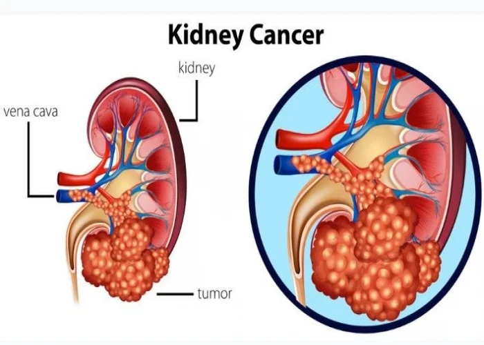 Kidney cancer