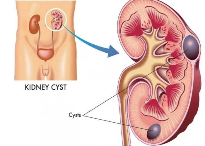 Kidney cysts