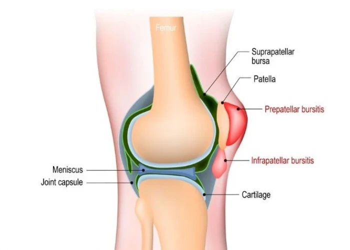 Knee bursitis