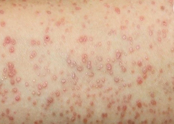 Lichen planus