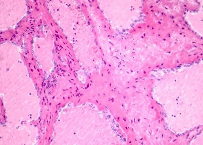 Liver hemangioma