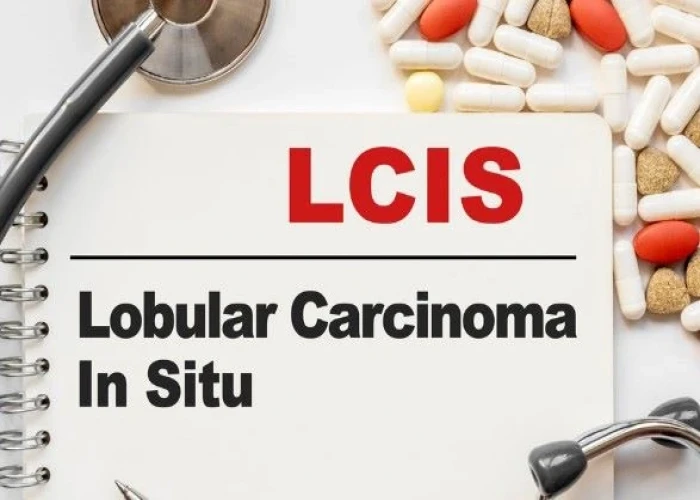 Lobular carcinoma in situ (LCIS)