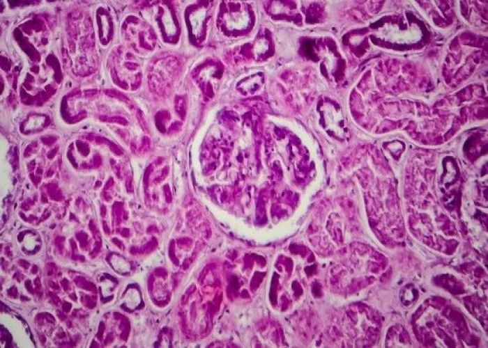 Lupus nephritis