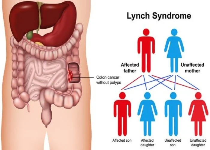 Lynch syndrome