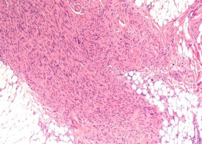 Malignant peripheral nerve sheath tumors