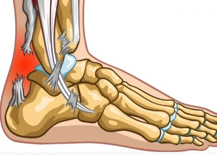 Median arcuate ligament syndrome (MALS)