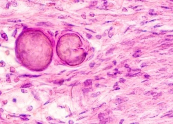 Meningioma