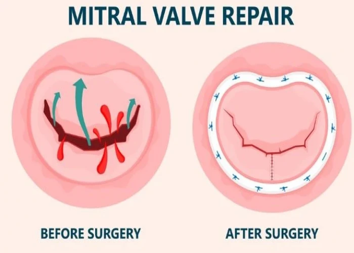 Mitral valve prolapse