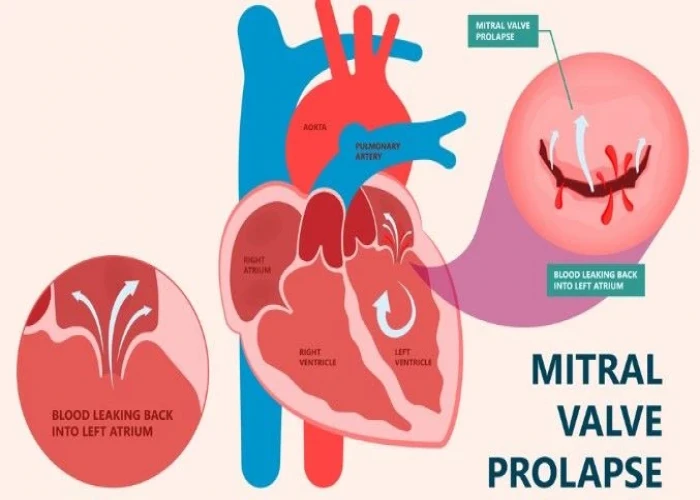 Mitral valve regurgitation