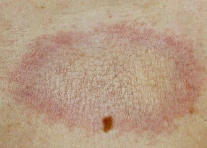 Morphea