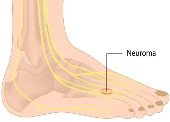 Morton's neuroma