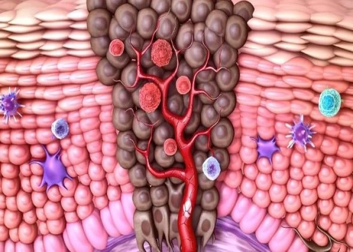 Multiple endocrine neoplasia, type 1 (MEN 1)