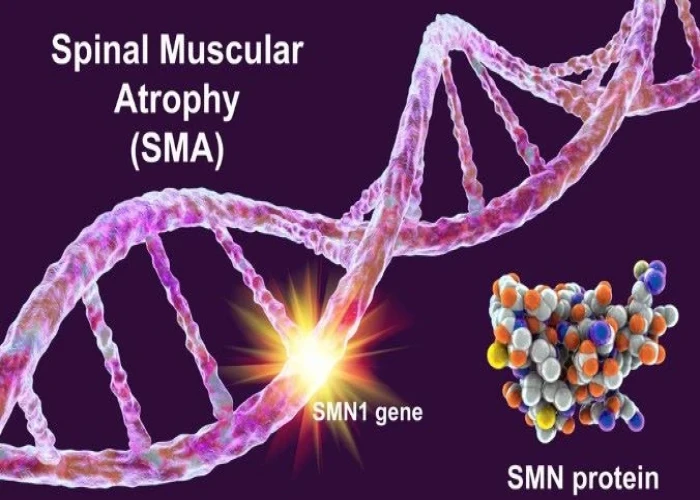 Multiple system atrophy (MSA)