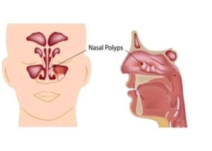 Nasal polyps