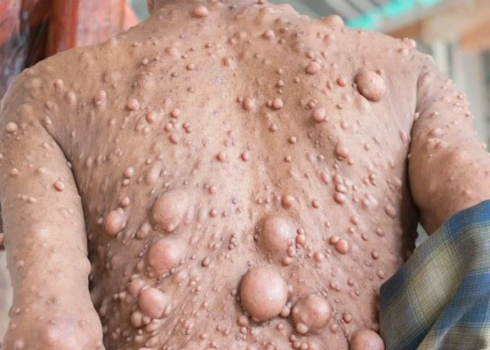 Neurofibromatosis