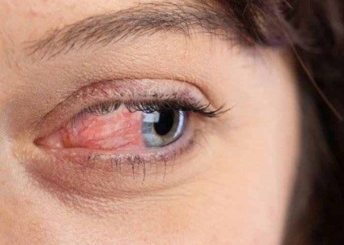 Ocular rosacea