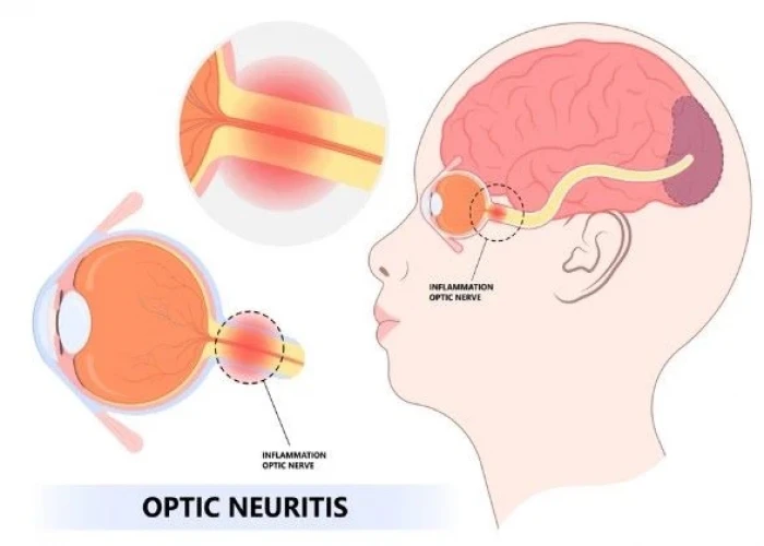 Optic neuritis