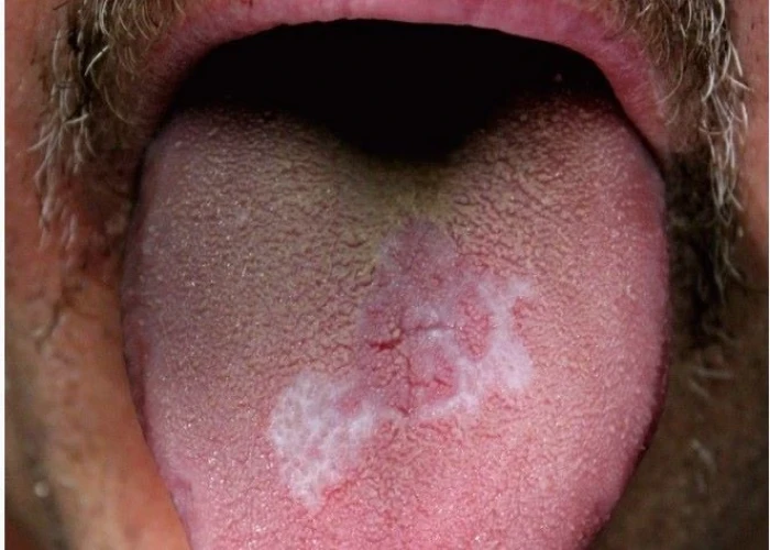 Oral lichen planus