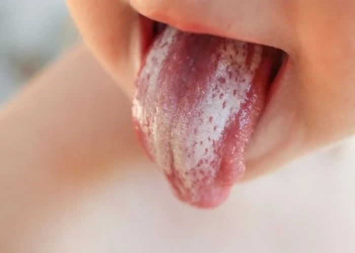 Oral thrush