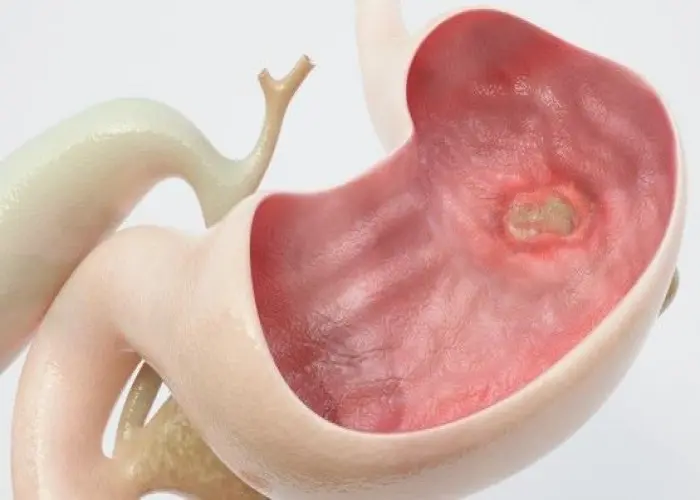 Gastric Ulcer