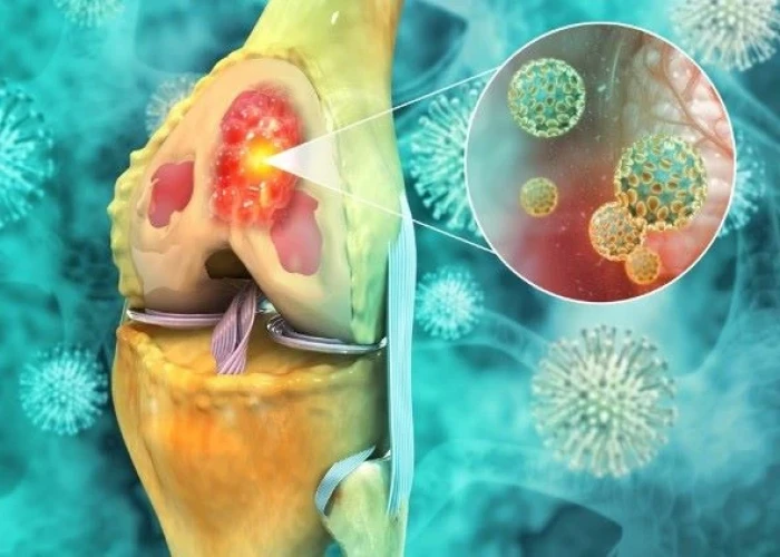 Osteosarcoma