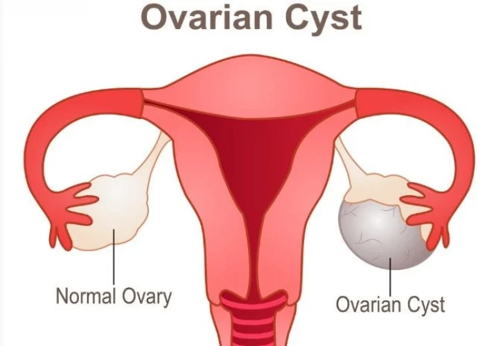 Ovarian cysts