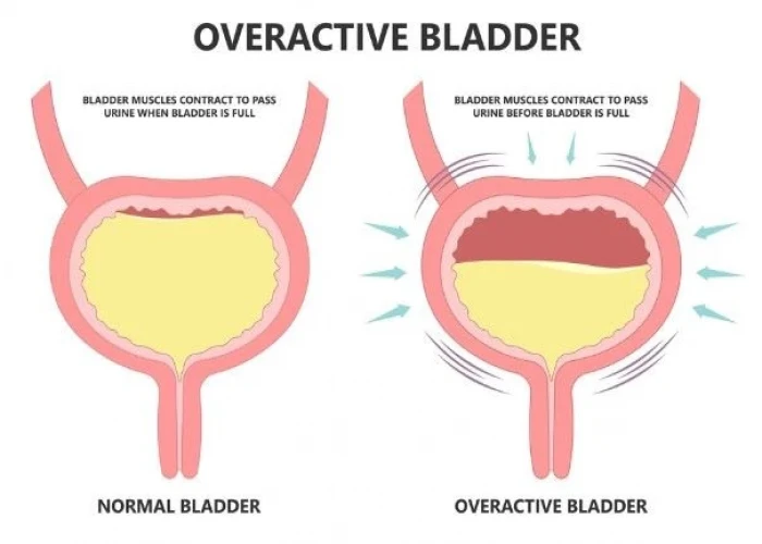 Overactive bladder