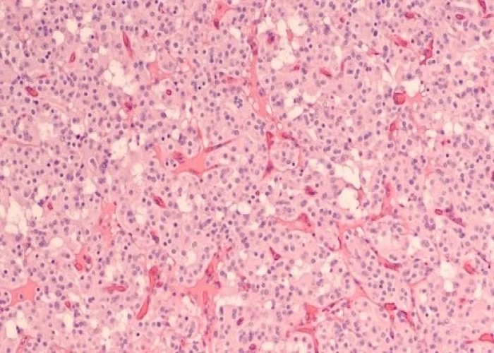 Pancreatic cysts