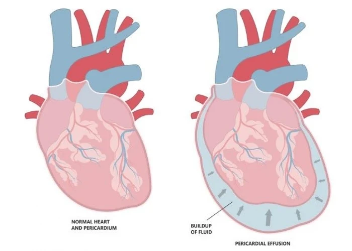 Pericardial effusion