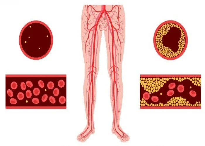 Peripheral artery disease (PAD)