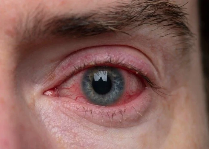 Pink eye (conjunctivitis)