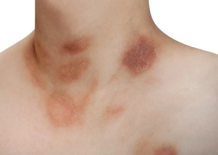 Pityriasis rosea