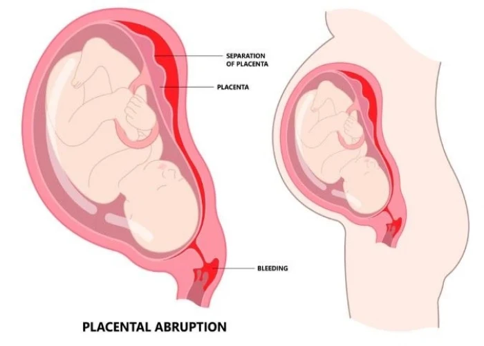 Placental abruption