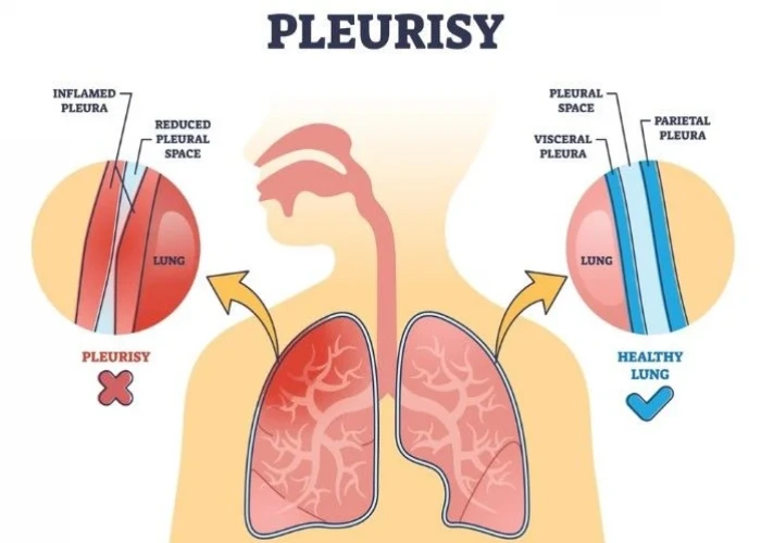 Pleurisy