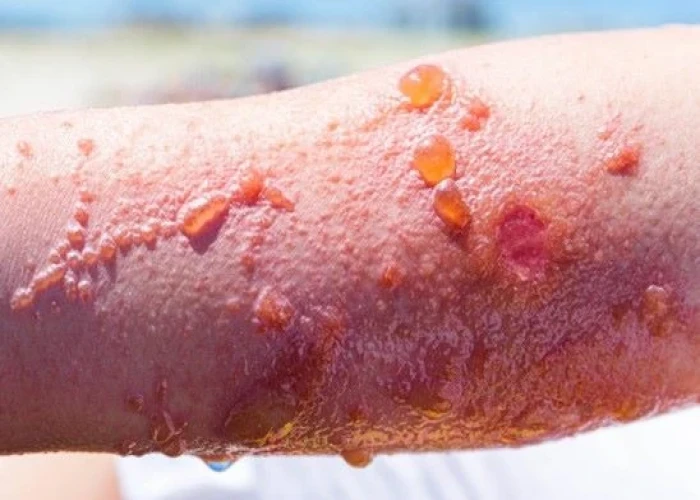 Poison ivy rash