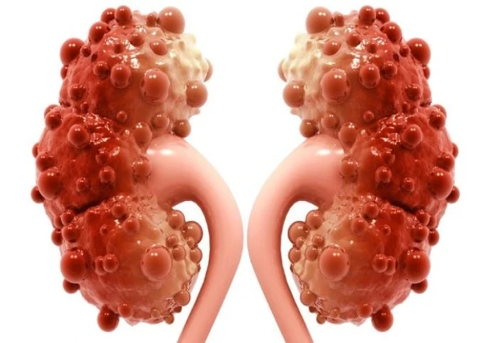 Polycystic kidney disease