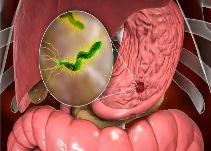 Duodenal Ulcer