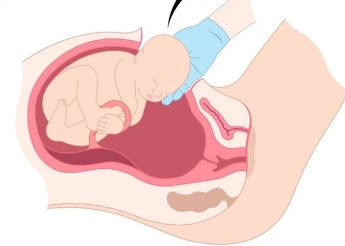 Postpartum preeclampsia