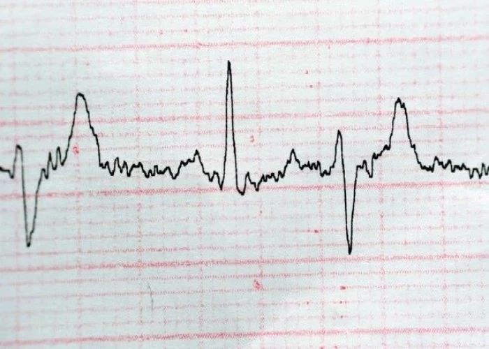 Premature ventricular contractions (PVCs)