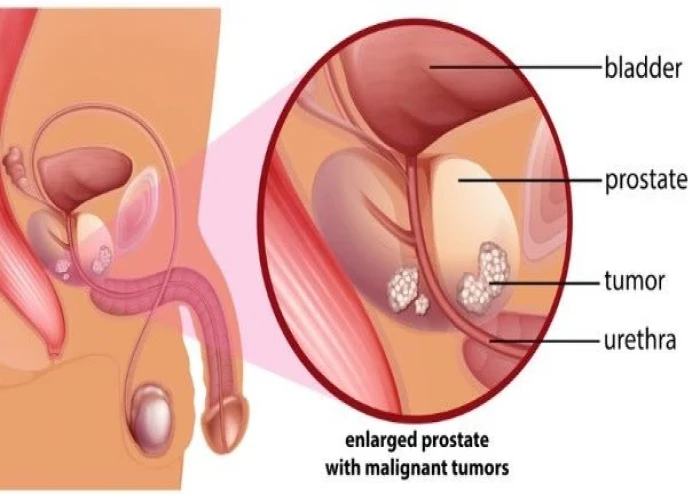 Prostate cancer