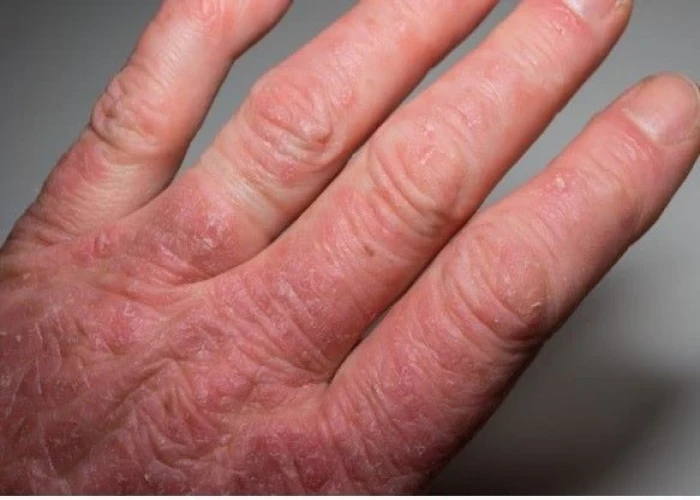 Psoriatic arthritis