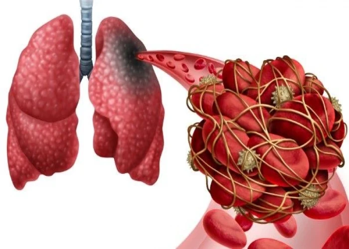 Pulmonary embolism