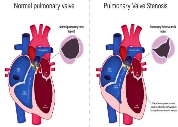 Pulmonary valve disease