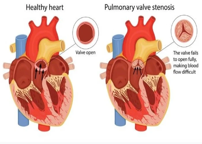 Pulmonary valve stenosis