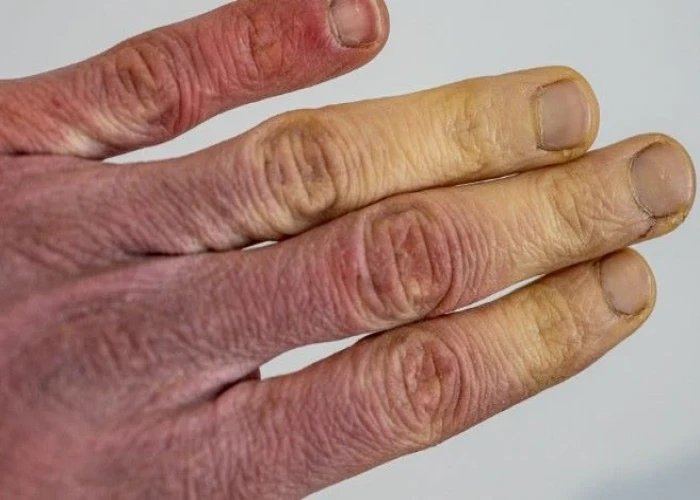 Raynaud's disease