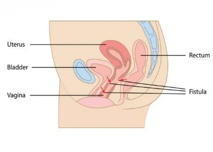 Rectovaginal fistula